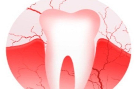 Кровоточивость десен: как справиться с проблемой с умом